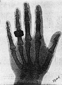 zdjęcie rentgenowskie wykonane przez Roentgena